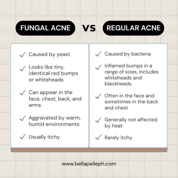 Effective Ways to Get Rid of Fungal Acne